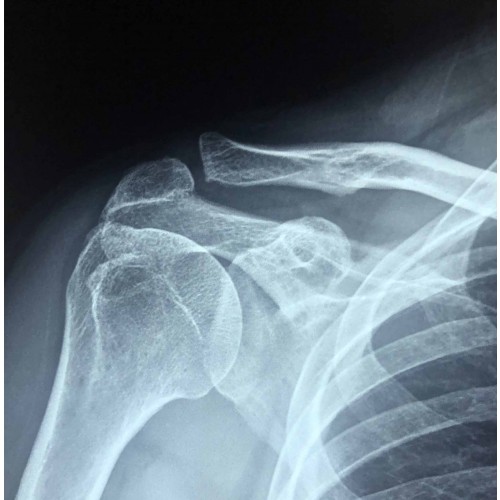 Broken 